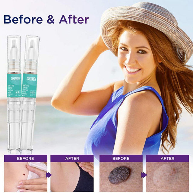 Remover Fast Remove All Moles Warts Spots Freckles anti Foot Corn Removal Warts Papillomas Rapidly Removes Moles