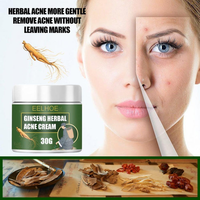 Ginseng Herb Anti-Acne Treatment Cream, Acne Removal, Fighting Breakouts, Spots, Cystic Acne with Natural Ingredients and Advanced Herbal Formula,50G