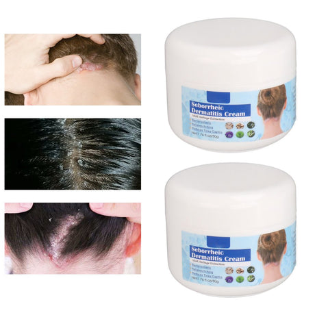 Seborrheic Dermatitis Cream, Scalp Treatment Cream 2Pcs Mild 1.8Oz Reduce Itching for Dry Skin