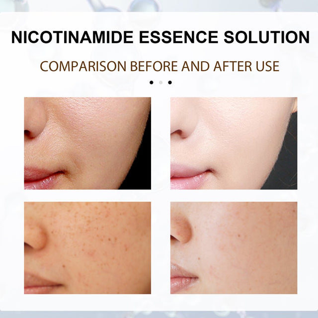 Niacinamide 5% Face Serum - Aging Skin Moisturizer - Diminishes Breakouts, Wrinkles, Lines, Age Spots