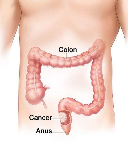 miracle-oxy-colon-cleanse-vegan-colon-cl-3.jpg