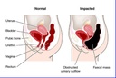 miracle-oxy-colon-2-day-colon-cleanser-a-5.jpg