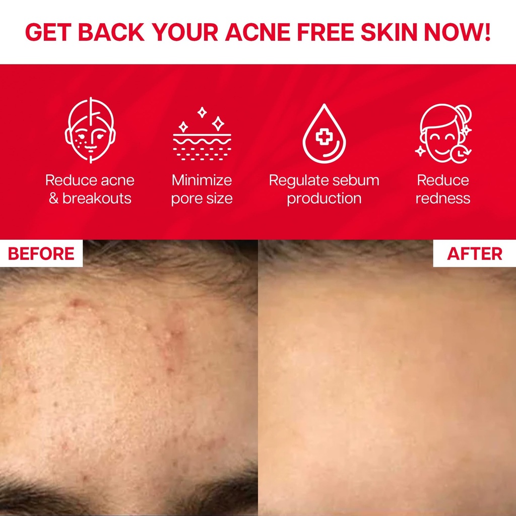 clear-it-acne-supplement-hormonal-cystic-5.jpg
