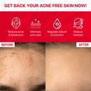 clear-it-acne-supplement-hormonal-cystic-5.jpg