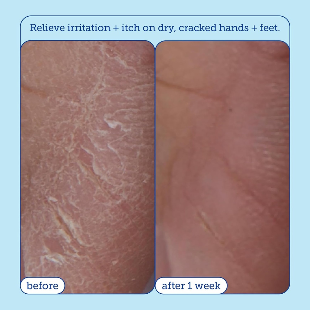 skinfix-eczema-hydrating-hand-repair-cre-4.jpg