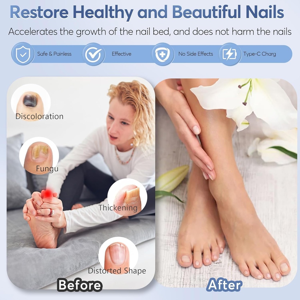 nail-fungus-laser-treatment-led-light-de-6.jpg