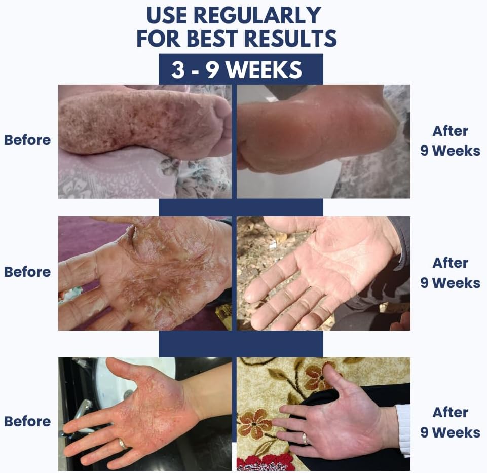 psodex-eczema-cream-moisturizing-eczema--4.jpg
