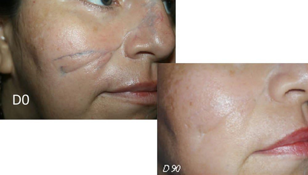 for-treatment-of-scars---30g---psoriasis-2.jpg