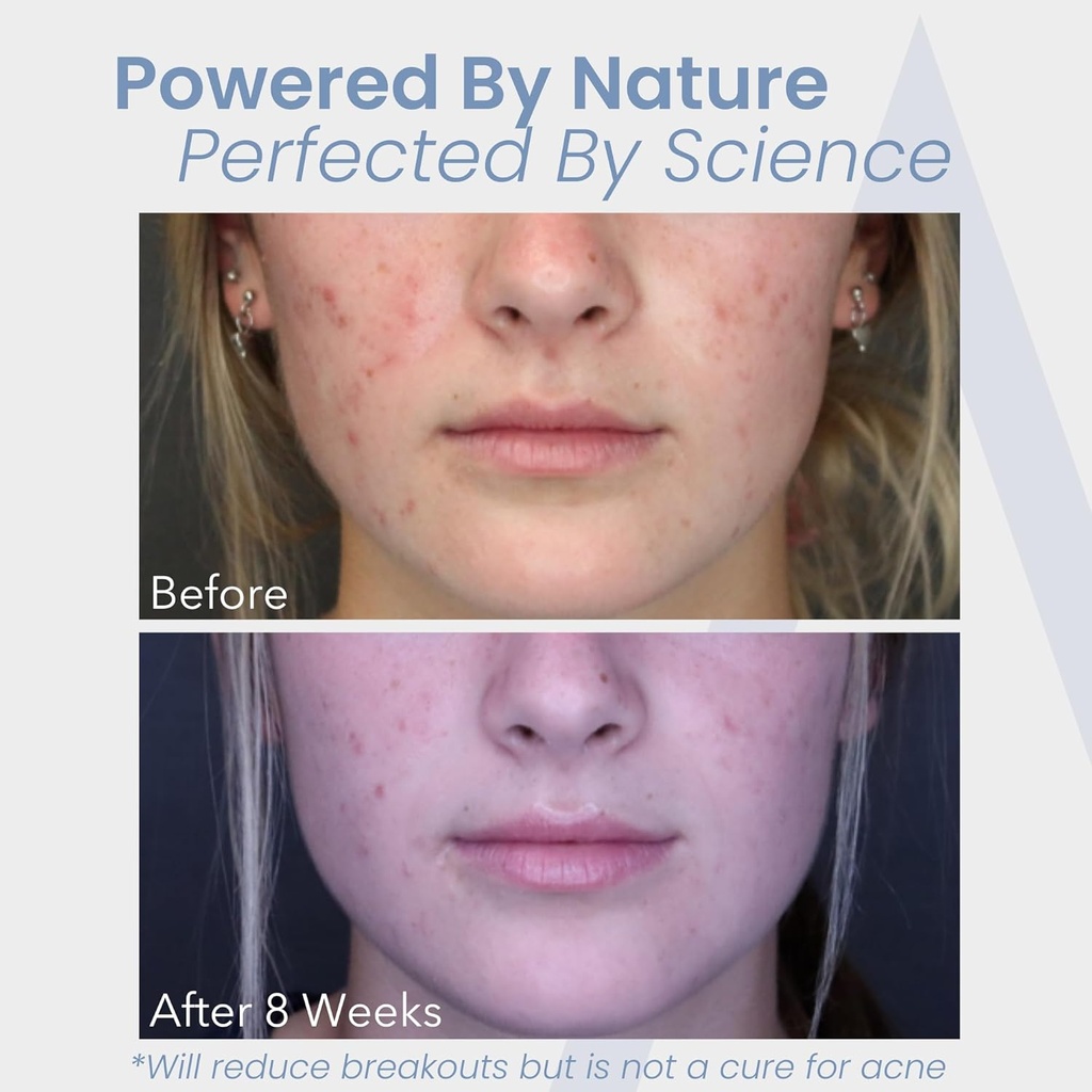 hormonal-acne-treatment-for-women---no-d-5.jpg