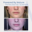 hormonal-acne-treatment-for-women---no-d-5.jpg