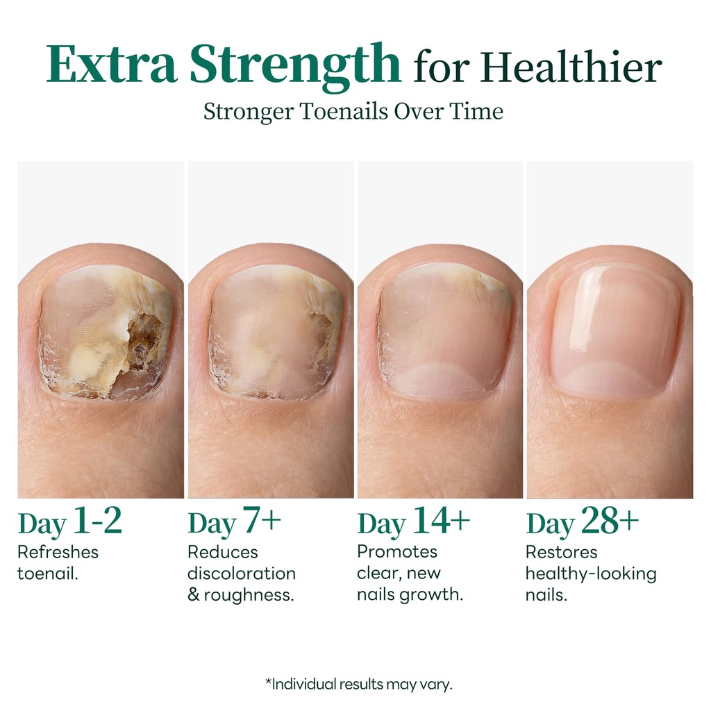 apuree-antifungal-pen-extra-strength-25--2.jpg