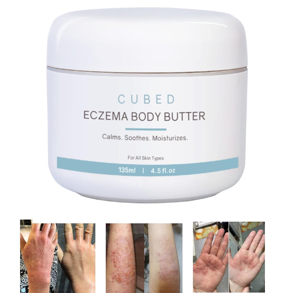 Crème d'eczéma en cubes de 4,5 oz pour adultes, soulagement de l'eczéma, traitement de l'eczéma, peau irritée sèche hydratante, lotion intelligente pour symptômes de sevrage stéroïdien topique, psoriasis et rosacée, eczéma, dermatite